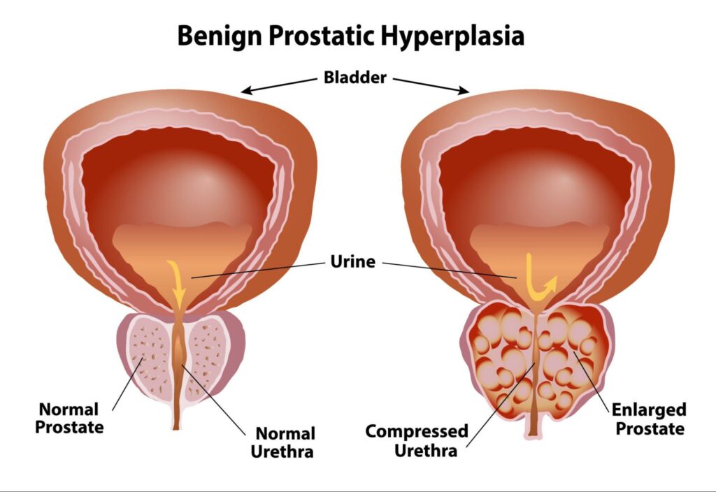 Benign-Prostatic-Hyperplasia-1024x704 Kidney