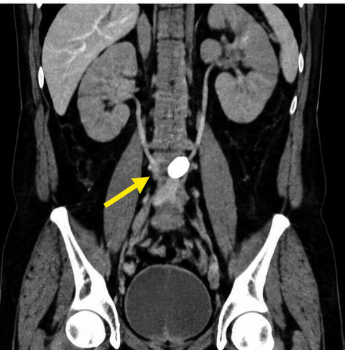 k5 kidney